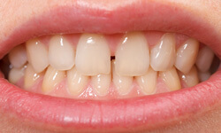 closeup of teeth with gaps 