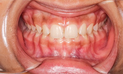 closeup of overbite 