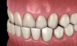 diagram of an underbite 