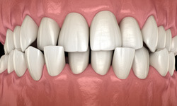 diagram of a crossbite 