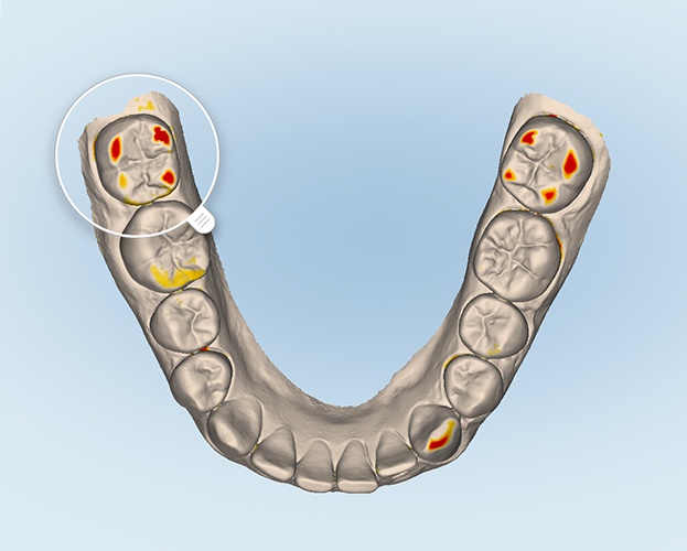 ITERO SCANNER — Valiente Dental