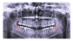 X-rays of impacted and partially erupted wisdom teeth